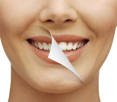 Blanchiment des dents Dr Salama dentiste Levallois