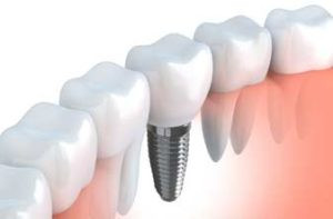 Implant dentaire Levallois Perret dr Salama